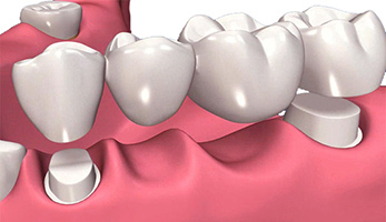 Dental Crowns Mississauga