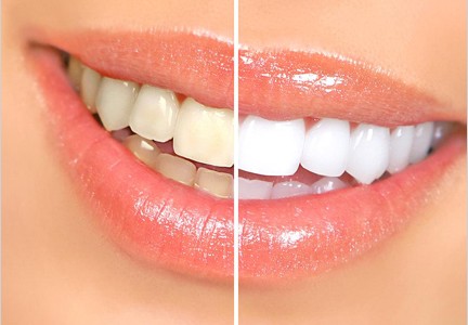 Teeth Whitening Mississauga