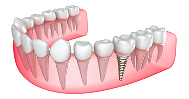 Dental Implants Mississauga